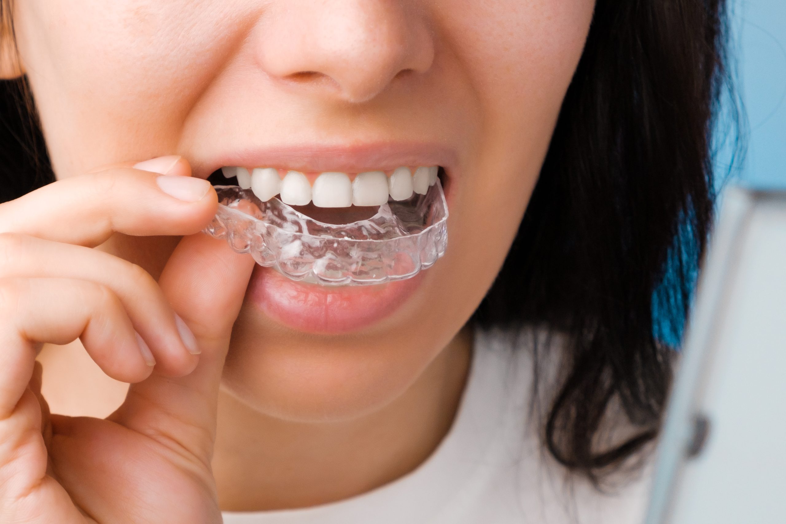 Dental Invisible Braces Singapore